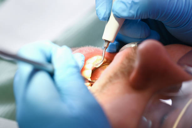 Best Emergency Root Canal Treatment in Morrow, OH